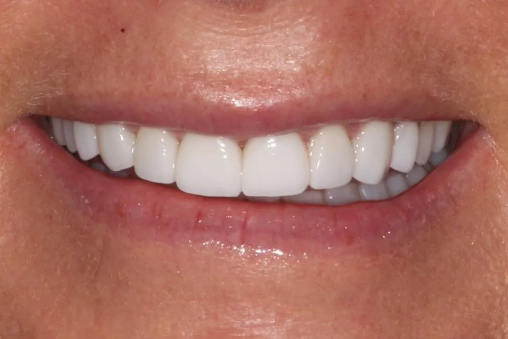 smile-makeover-1-after