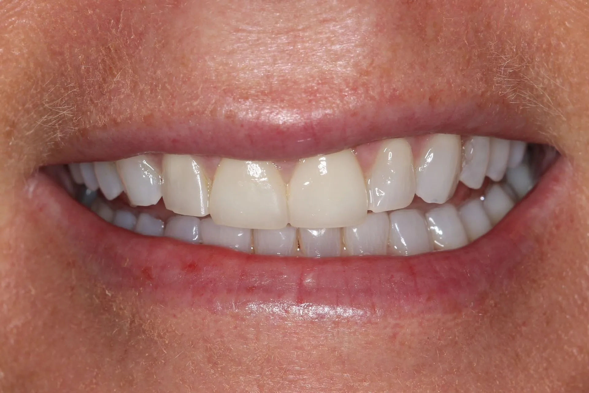 smile-makeover-1-before