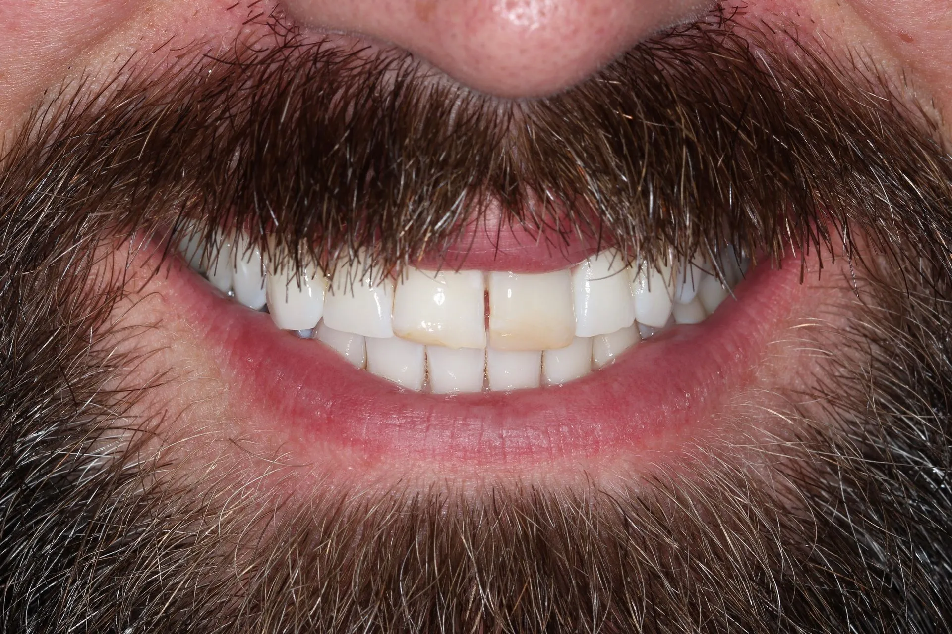 smile-makeover-2-before