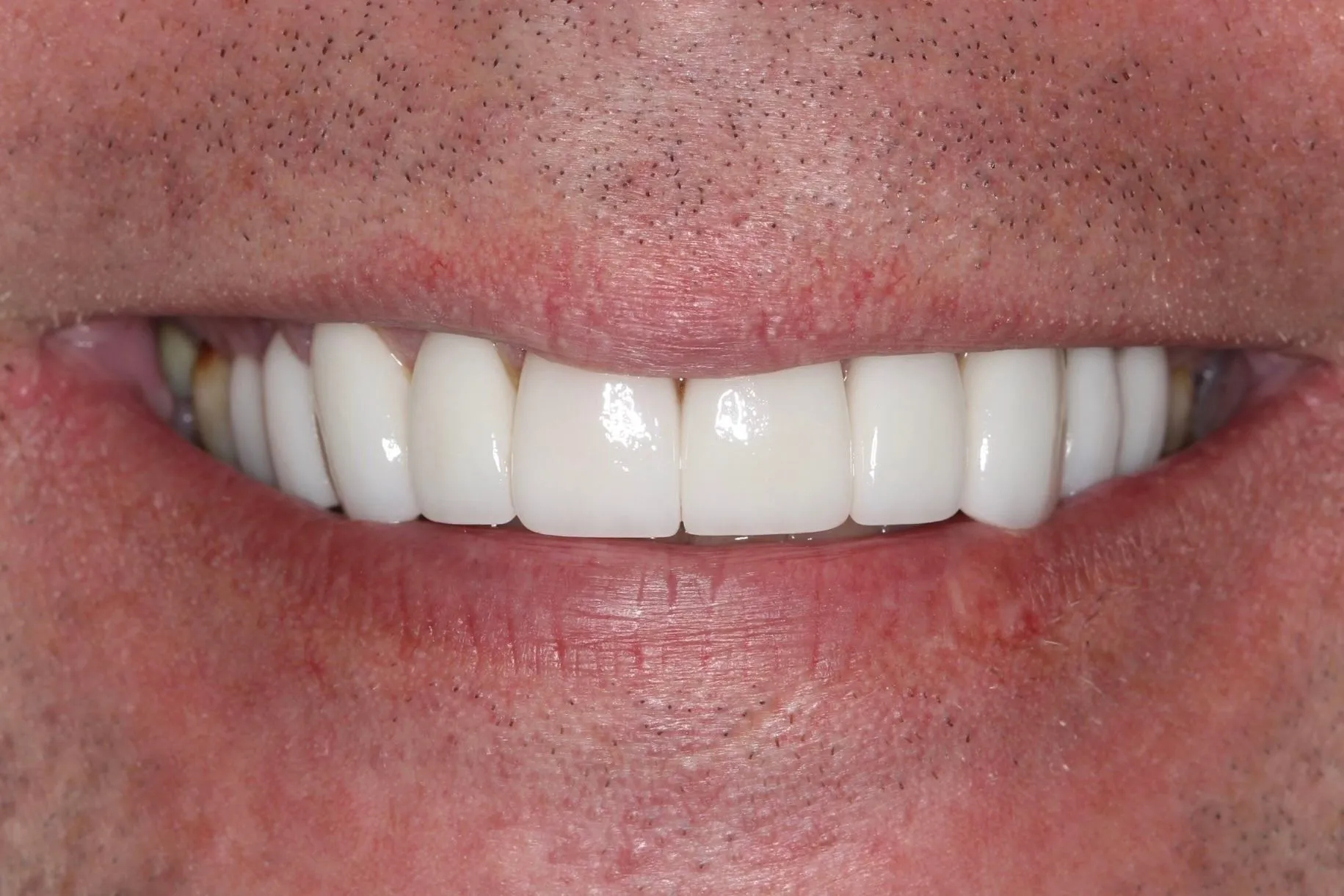 smile-makeover-3-after