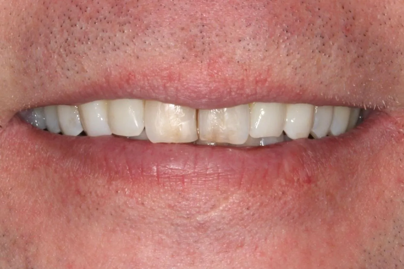 smile-makeover-3-before