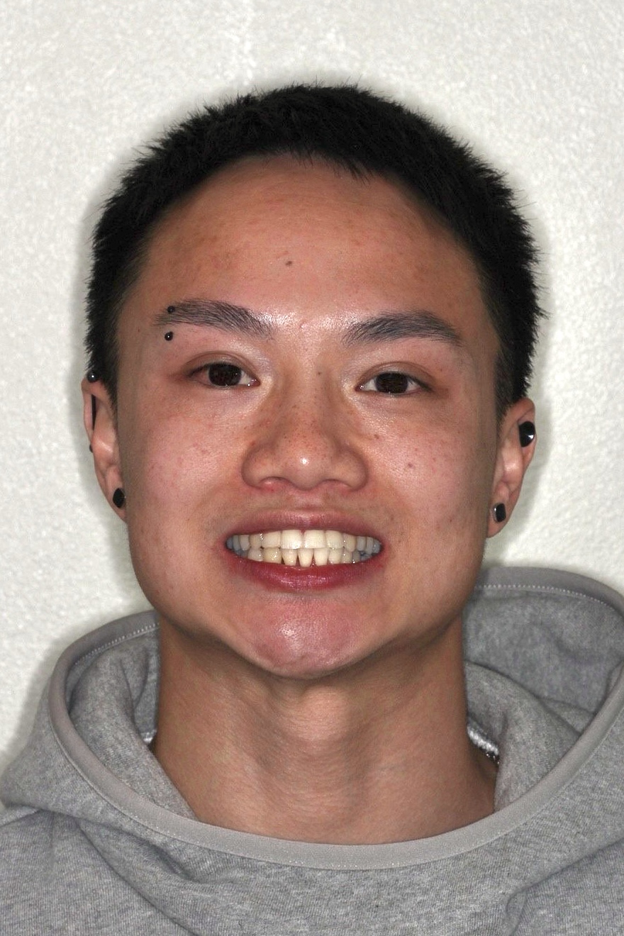 gnwd-invisalign after-june-02 headshot