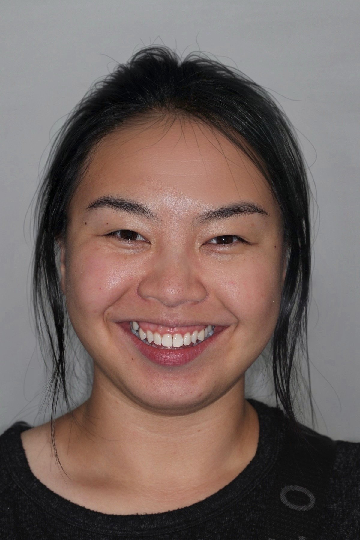 gnwd-invisalign after-june-04 headshot