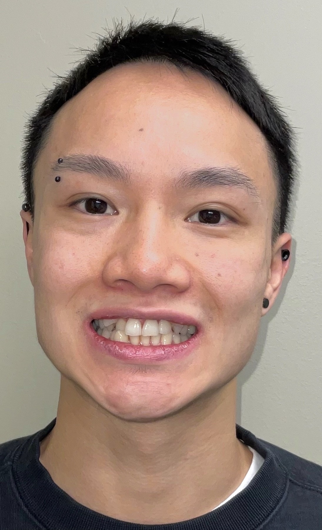 gnwd-invisalign before june-02 headshot